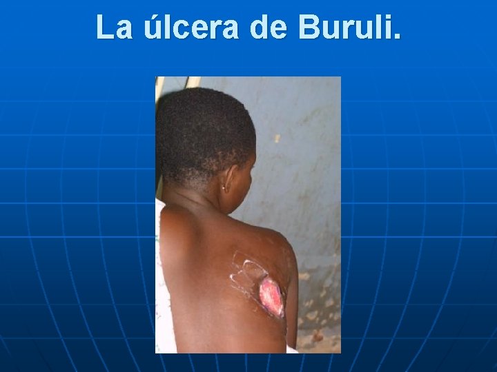 La úlcera de Buruli. 