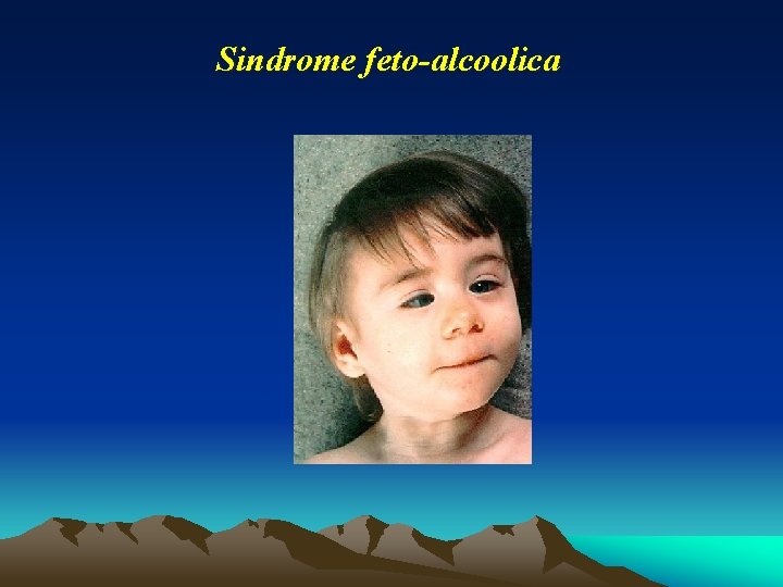 Sindrome feto-alcoolica Sindrome feto-alcoolica