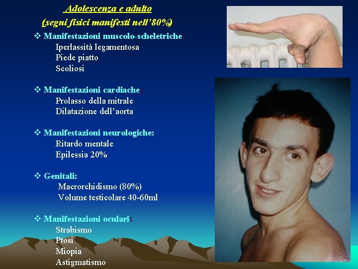 Adolescenza e adulto (segni fisici manifesti nell’ 80%) v Manifestazioni muscolo-scheletriche: Iperlassità legamentosa Piede Adolescenza e adulto (segni fisici manifesti nell’ 80%) v Manifestazioni muscolo-scheletriche: Iperlassità legamentosa Piede