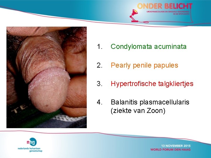 1. Condylomata acuminata 2. Pearly penile papules 3. Hypertrofische talgkliertjes 4. Balanitis plasmacellularis (ziekte 1. Condylomata acuminata 2. Pearly penile papules 3. Hypertrofische talgkliertjes 4. Balanitis plasmacellularis (ziekte