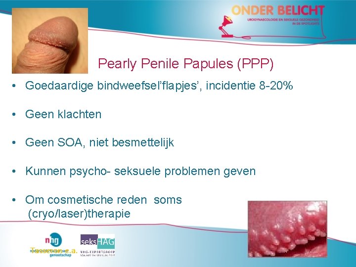 Pearly Penile Papules (PPP) • Goedaardige bindweefsel’flapjes’, incidentie 8 -20% • Geen klachten • Pearly Penile Papules (PPP) • Goedaardige bindweefsel’flapjes’, incidentie 8 -20% • Geen klachten •