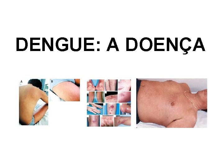 DENGUE: A DOENÇA DENGUE: A DOENÇA