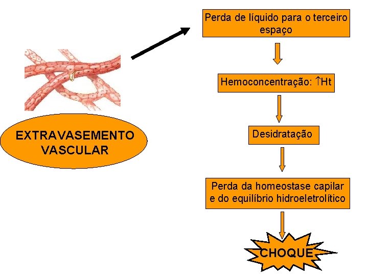 Perda de líquido para o terceiro espaço Hemoconcentração: Ht EXTRAVASEMENTO VASCULAR Desidratação Perda da Perda de líquido para o terceiro espaço Hemoconcentração: Ht EXTRAVASEMENTO VASCULAR Desidratação Perda da