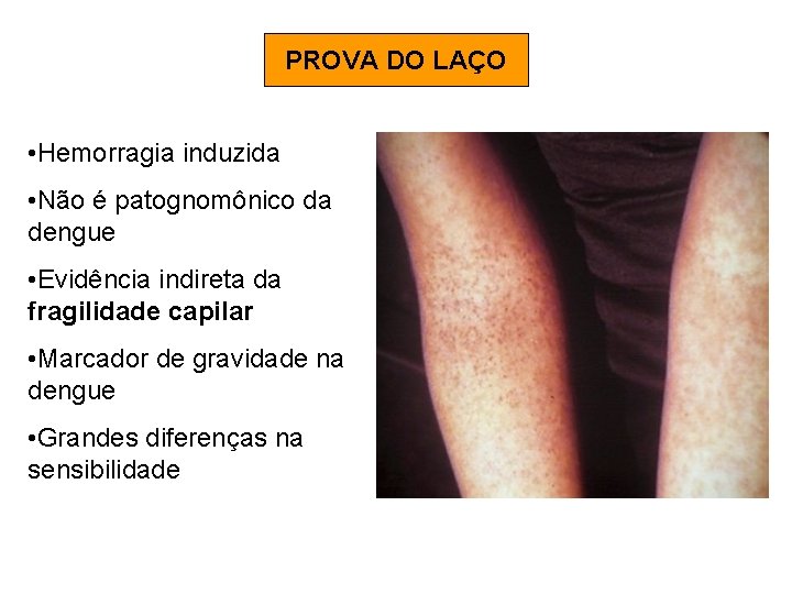 PROVA DO LAÇO • Hemorragia induzida • Não é patognomônico da dengue • Evidência PROVA DO LAÇO • Hemorragia induzida • Não é patognomônico da dengue • Evidência