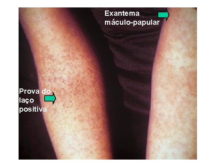 Exantema máculo-papular Prova do laço positiva Exantema máculo-papular Prova do laço positiva