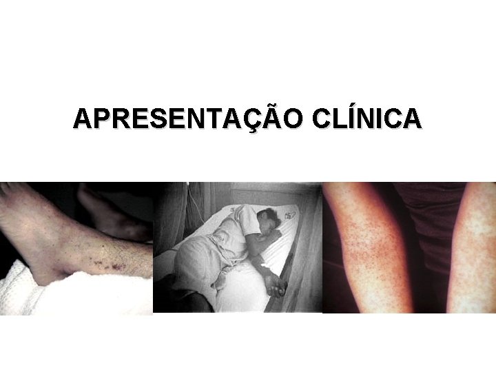 APRESENTAÇÃO CLÍNICA APRESENTAÇÃO CLÍNICA