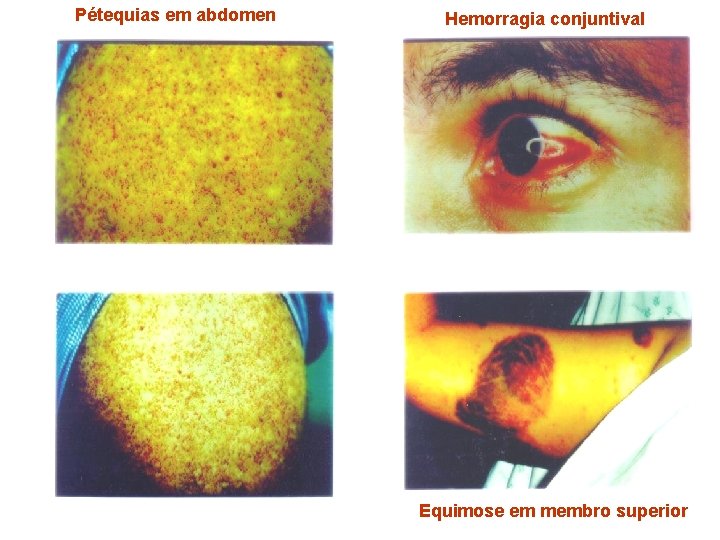 Pétequias em abdomen Hemorragia conjuntival Equimose em membro superior Pétequias em abdomen Hemorragia conjuntival Equimose em membro superior