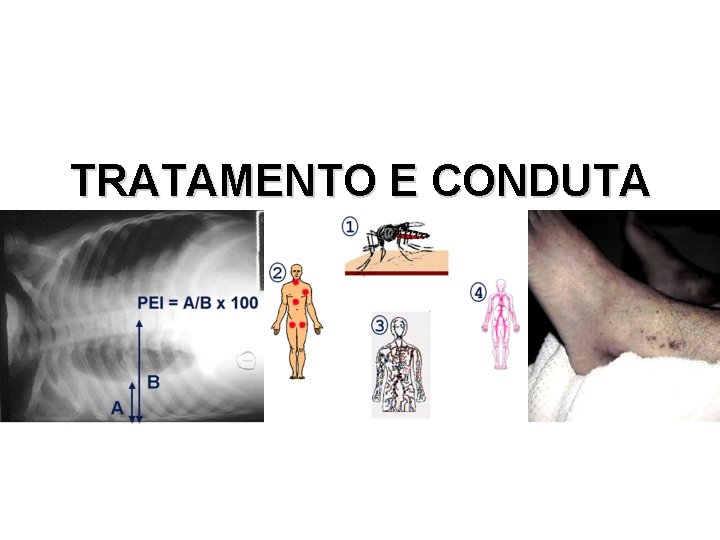 TRATAMENTO E CONDUTA TRATAMENTO E CONDUTA