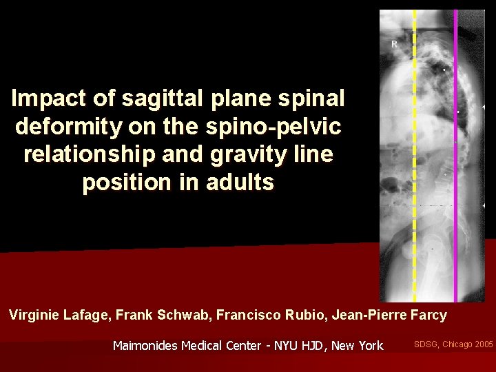 Impact of sagittal plane spinal deformity on the spino-pelvic relationship and gravity line position