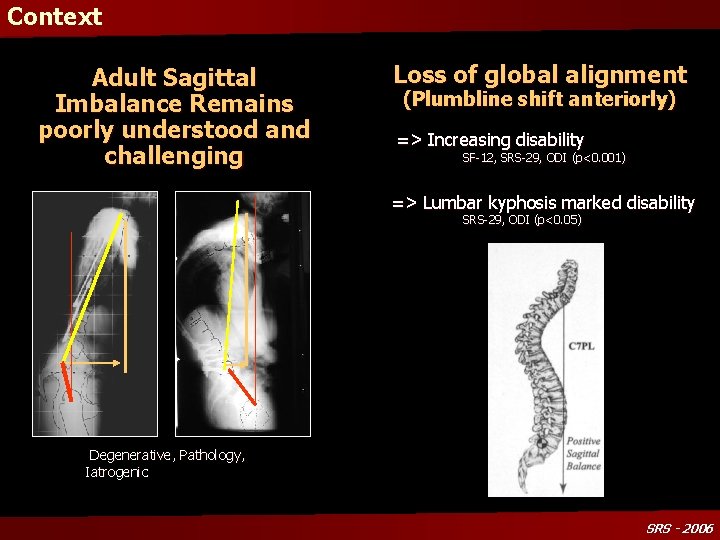 Context Adult Sagittal Imbalance Remains poorly understood and challenging Loss of global alignment (Plumbline