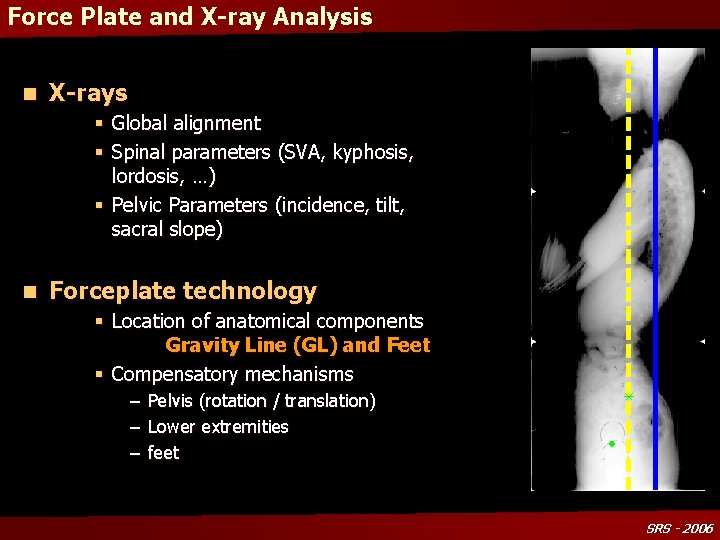 Force Plate and X-ray Analysis n X-rays § Global alignment § Spinal parameters (SVA,