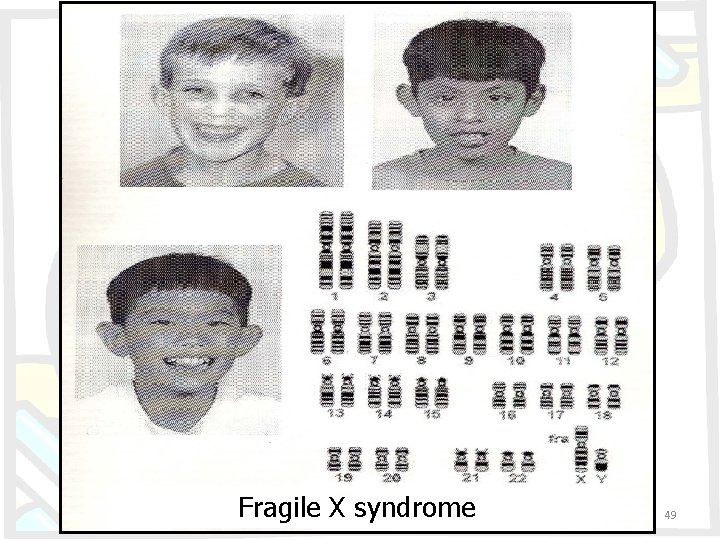 Fragile X syndrome 49 