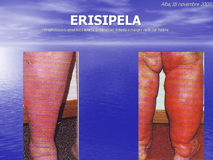 Alba, 16 novembre 2007 ERISIPELA (streptococco b emolitico) edema eritematoso dolente a margini netti Alba, 16 novembre 2007 ERISIPELA (streptococco b emolitico) edema eritematoso dolente a margini netti