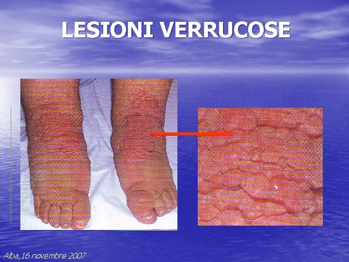 LESIONI VERRUCOSE Alba, 16 novembre 2007 LESIONI VERRUCOSE Alba, 16 novembre 2007