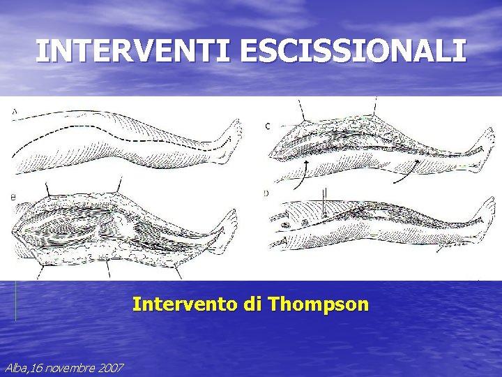 INTERVENTI ESCISSIONALI Intervento di Thompson Alba, 16 novembre 2007 INTERVENTI ESCISSIONALI Intervento di Thompson Alba, 16 novembre 2007