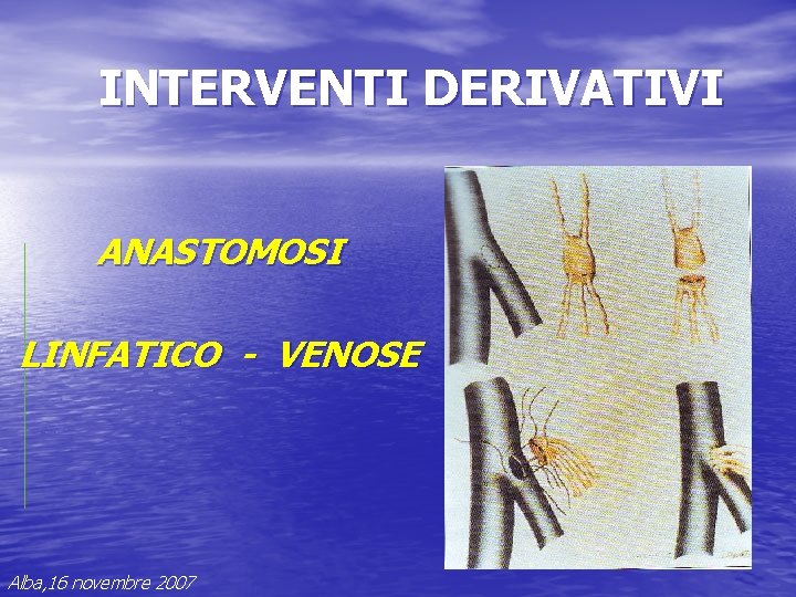 INTERVENTI DERIVATIVI ANASTOMOSI LINFATICO - VENOSE Alba, 16 novembre 2007 INTERVENTI DERIVATIVI ANASTOMOSI LINFATICO - VENOSE Alba, 16 novembre 2007