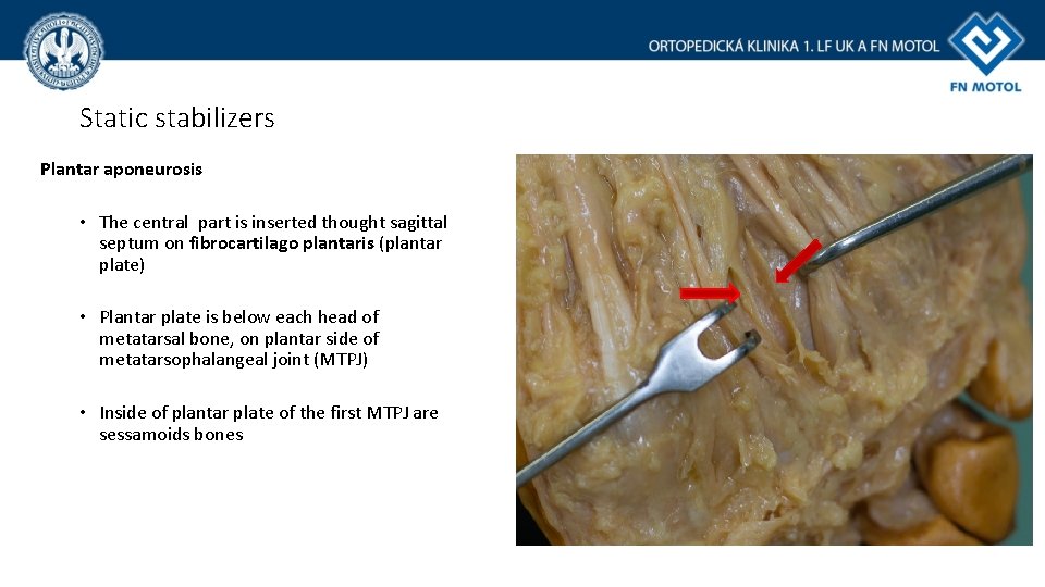 Static stabilizers Plantar aponeurosis • The central part is inserted thought sagittal septum on Static stabilizers Plantar aponeurosis • The central part is inserted thought sagittal septum on