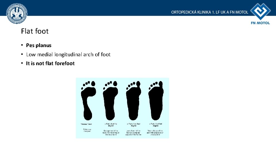Flat foot • Pes planus • Low medial longitudinal arch of foot • It Flat foot • Pes planus • Low medial longitudinal arch of foot • It