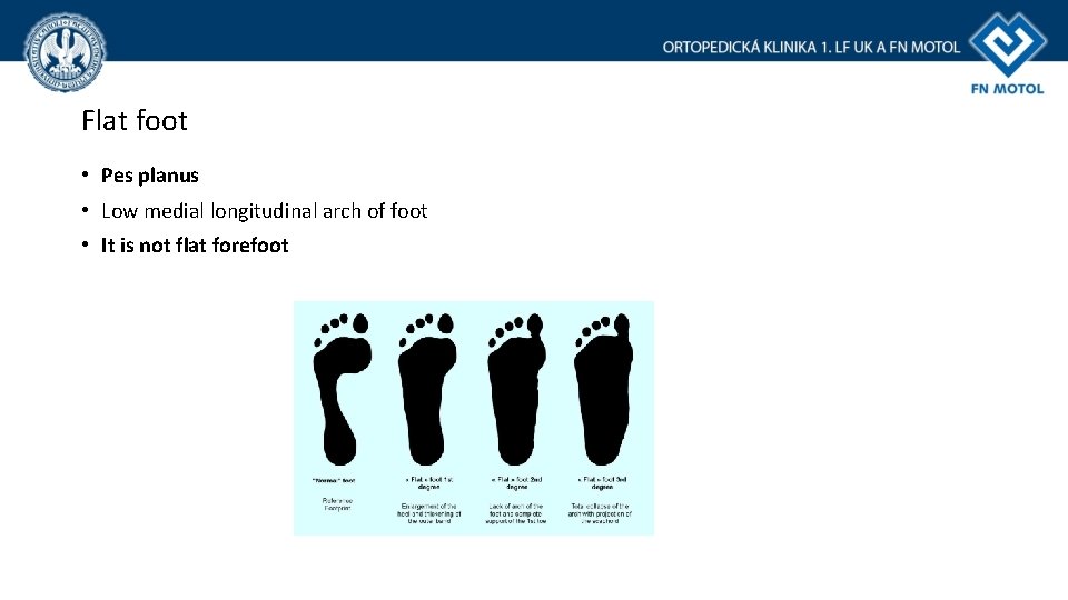 Flat foot • Pes planus • Low medial longitudinal arch of foot • It