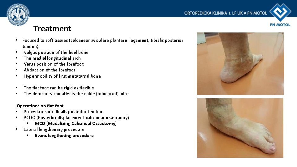 Treatment • • • Focused to soft tissues (calcaneonaviculare plantare liagament, tibialis posterior tendon) Treatment • • • Focused to soft tissues (calcaneonaviculare plantare liagament, tibialis posterior tendon)