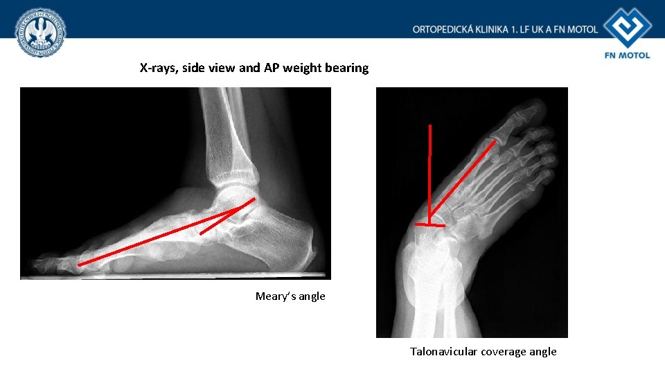 X-rays, side view and AP weight bearing Meary’s angle Talonavicular coverage angle 