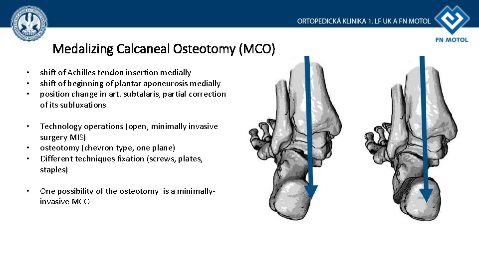 Medalizing Calcaneal Osteotomy (MCO) • • • shift of Achilles tendon insertion medially shift Medalizing Calcaneal Osteotomy (MCO) • • • shift of Achilles tendon insertion medially shift