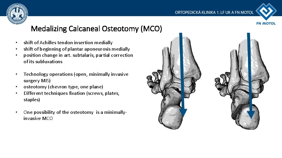 Medalizing Calcaneal Osteotomy (MCO) • • • shift of Achilles tendon insertion medially shift