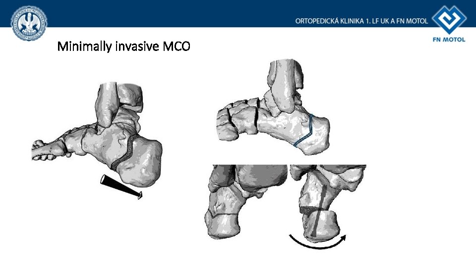 Minimally invasive MCO 