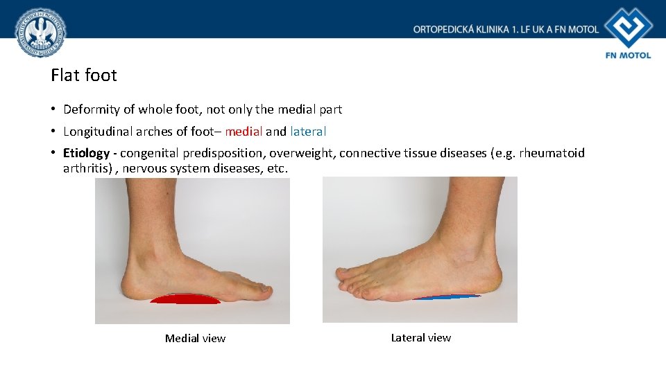 Flat foot • Deformity of whole foot, not only the medial part • Longitudinal