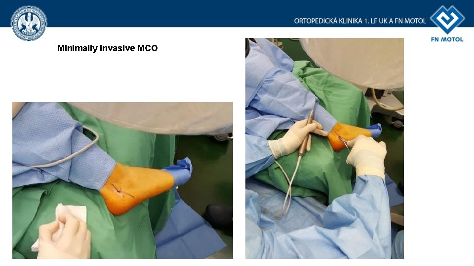 Minimally invasive MCO Minimally invasive MCO