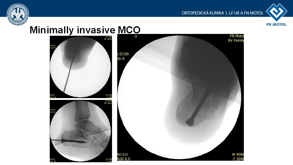 Minimally invasive MCO 