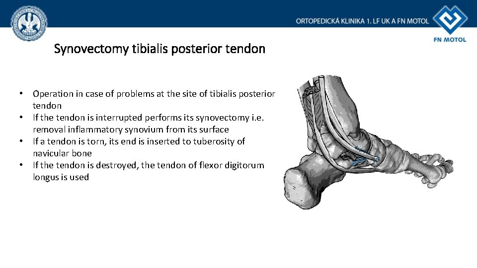 Synovectomy tibialis posterior tendon • Operation in case of problems at the site of Synovectomy tibialis posterior tendon • Operation in case of problems at the site of