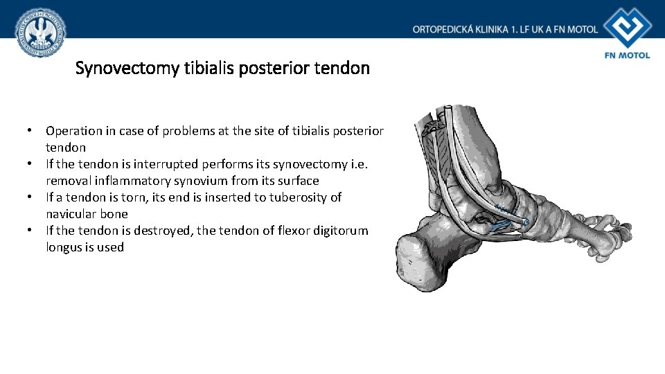 Synovectomy tibialis posterior tendon • Operation in case of problems at the site of