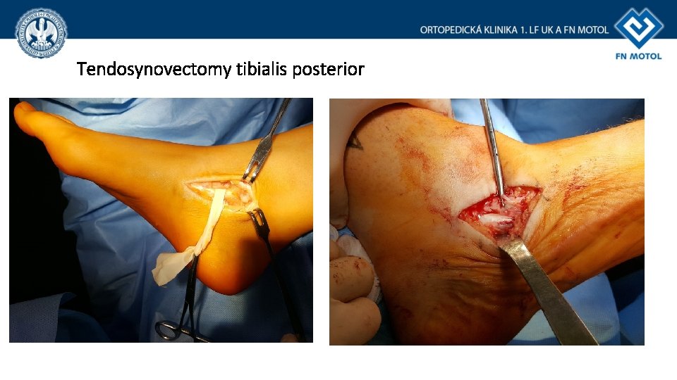 Tendosynovectomy tibialis posterior Tendosynovectomy tibialis posterior