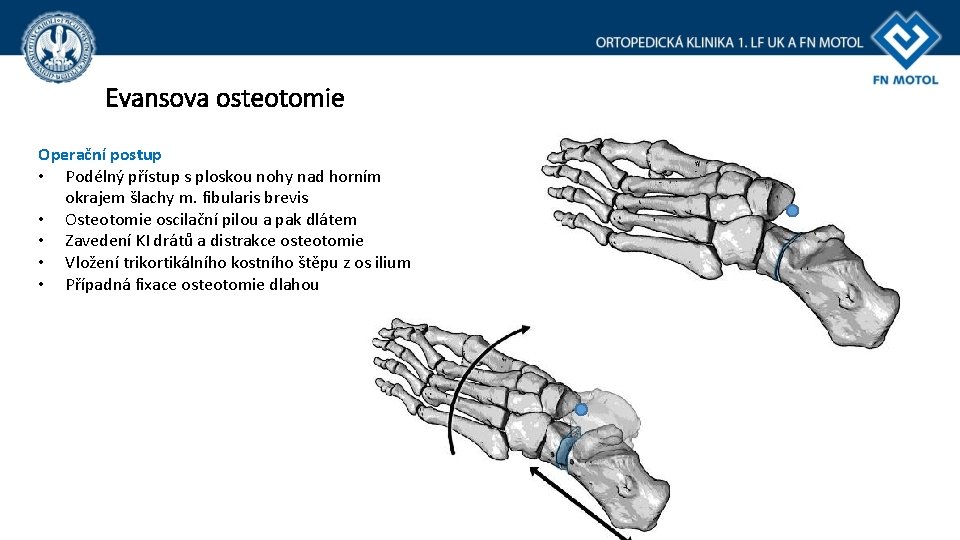 Evansova osteotomie Operační postup • Podélný přístup s ploskou nohy nad horním okrajem šlachy