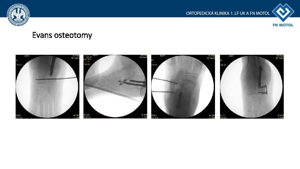Evans osteotomy Evans osteotomy