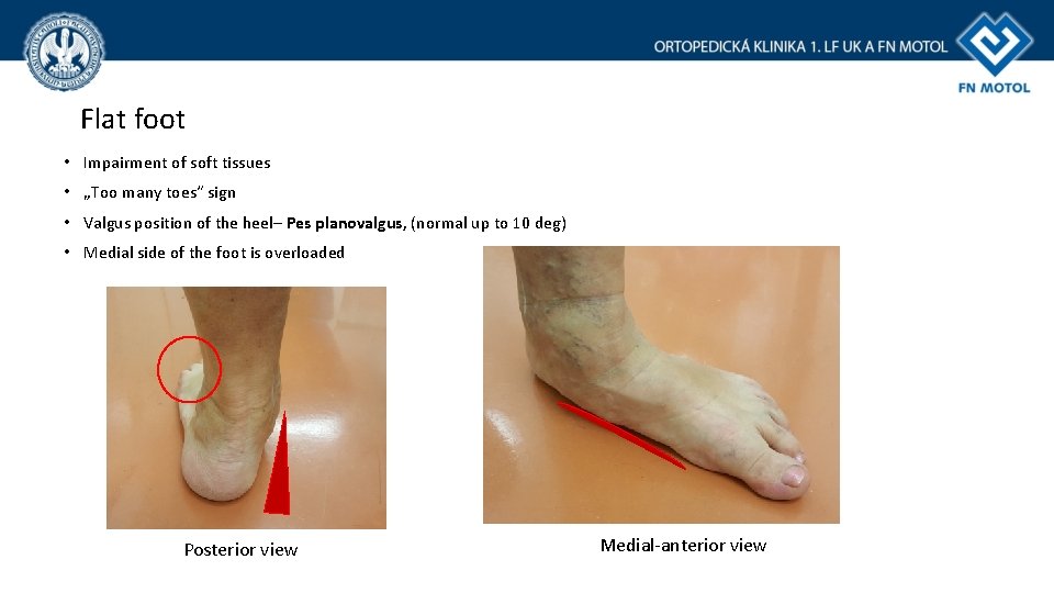 Flat foot • Impairment of soft tissues • „Too many toes“ sign • Valgus
