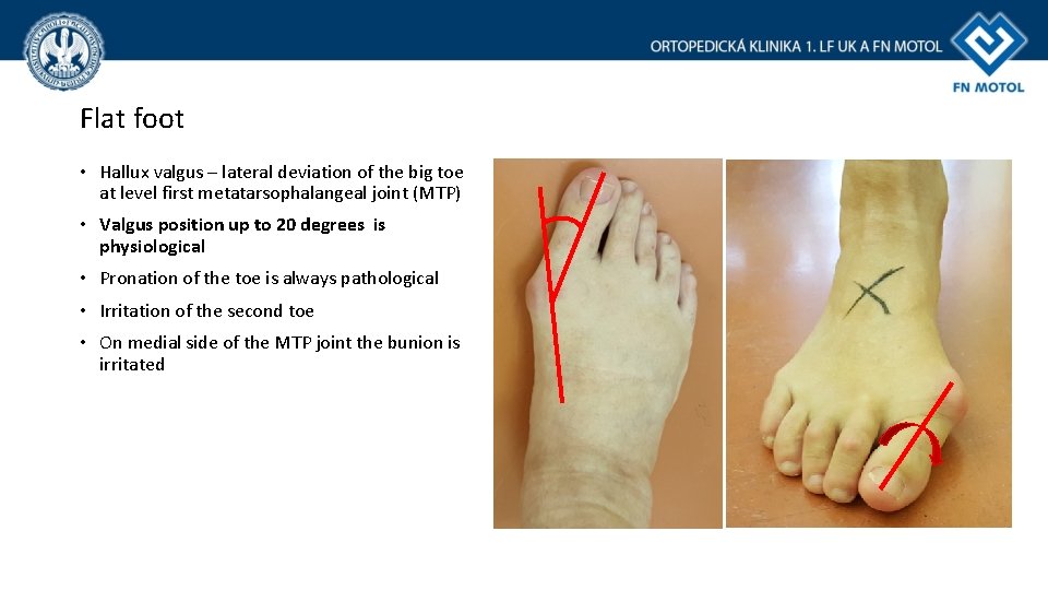 Flat foot • Hallux valgus – lateral deviation of the big toe at level Flat foot • Hallux valgus – lateral deviation of the big toe at level