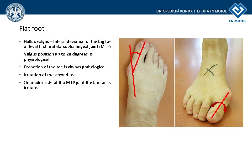 Flat foot • Hallux valgus – lateral deviation of the big toe at level