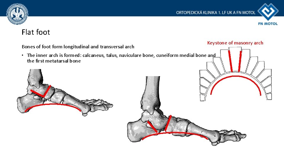 Flat foot Bones of foot form longitudinal and transversal arch Keystone of masonry arch