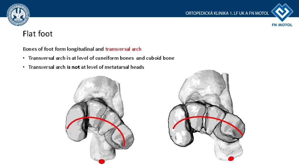 Flat foot Bones of foot form longitudinal and transversal arch • Transversal arch is
