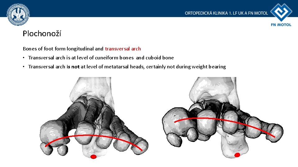 Plochonoží Bones of foot form longitudinal and transversal arch • Transversal arch is at