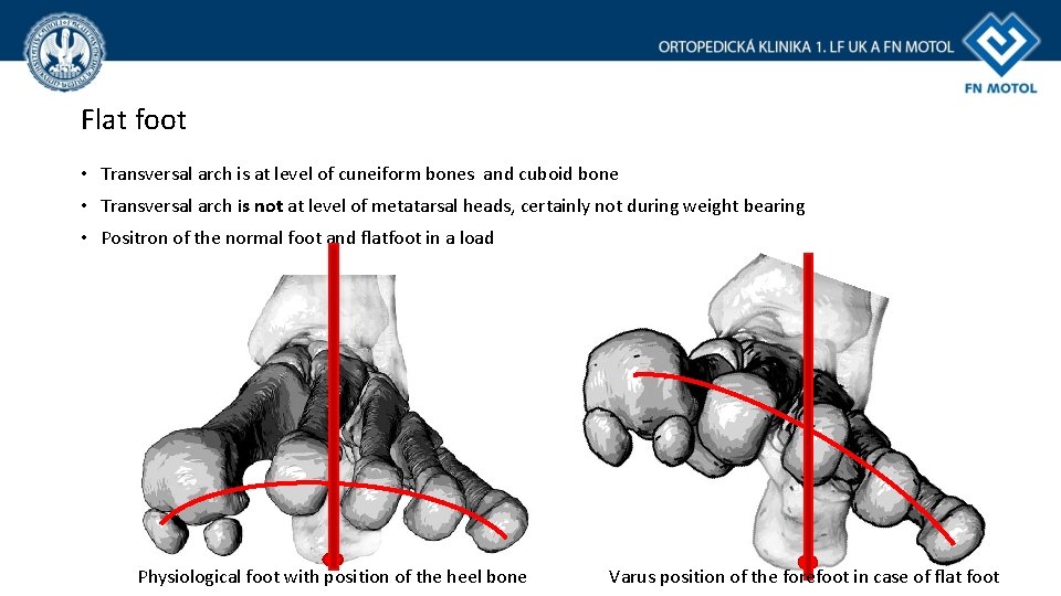 Flat foot • Transversal arch is at level of cuneiform bones and cuboid bone