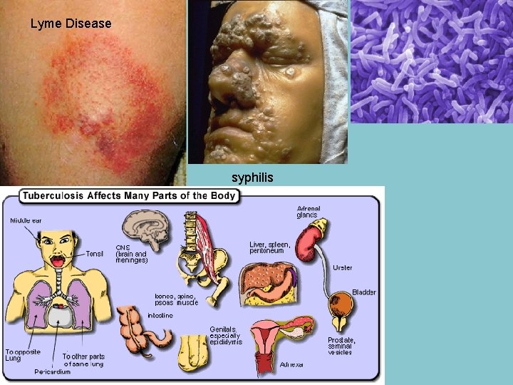 Lyme Disease syphilis 