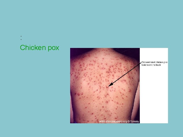 : Chicken pox 