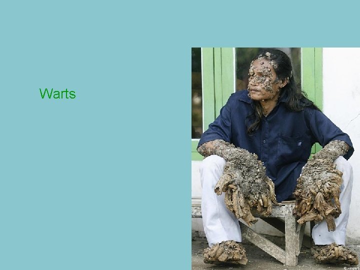 Warts 