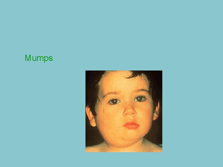 Mumps 