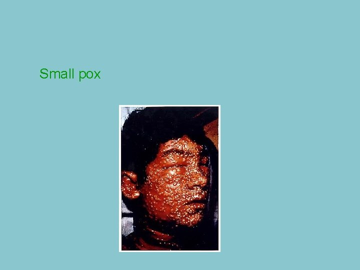Small pox 