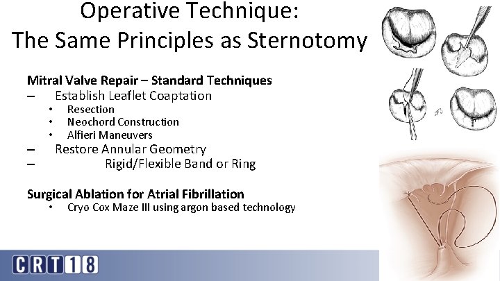 Operative Technique: The Same Principles as Sternotomy Mitral Valve Repair – Standard Techniques –