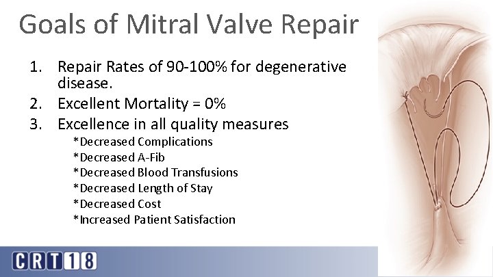 Goals of Mitral Valve Repair 1. Repair Rates of 90 -100% for degenerative disease.